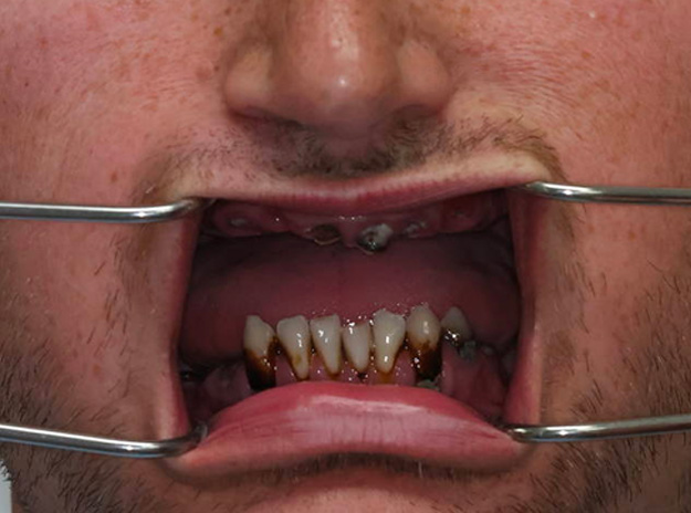 whole mouth dental implants