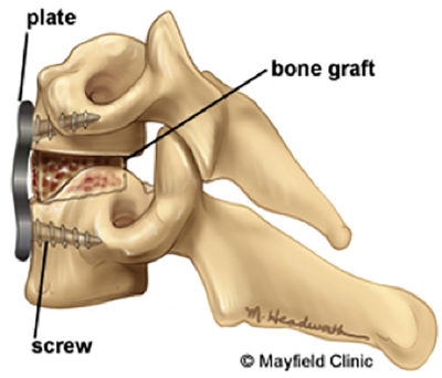 Navigating Spine Care: How to Find the Best Spine Surgeon in New York