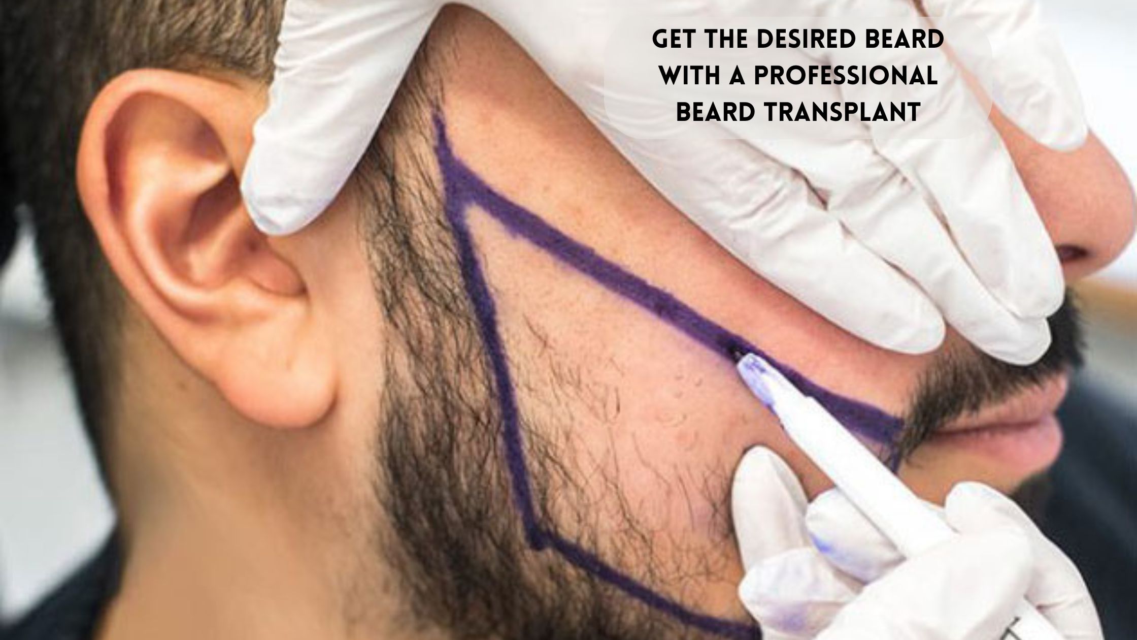 Beard transplant