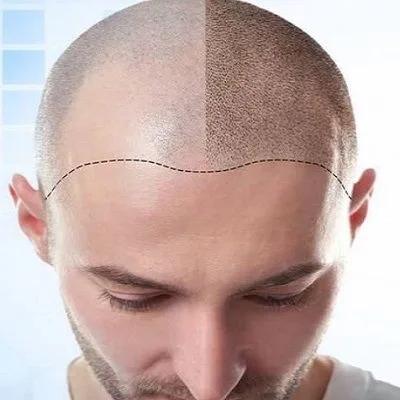 Thinking about a hair transplant in Dubai? Discover everything you need to know about success rates, recovery time, techniques