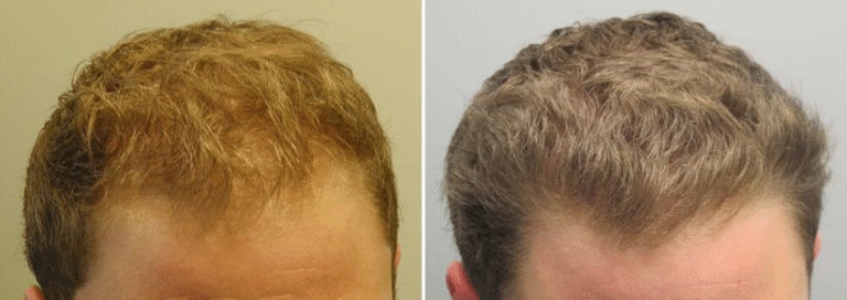 Finasteride