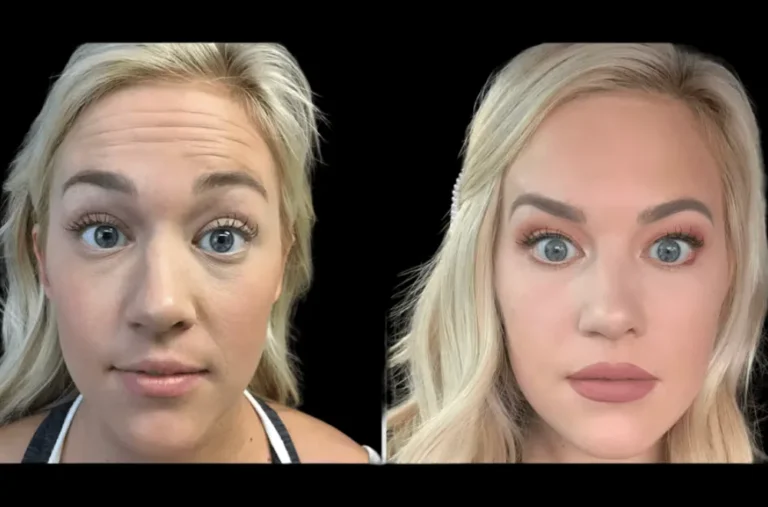 Is Botox Safe? Insights from the Best Aesthetic Clinics in dubai