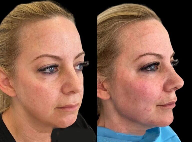 The Best Plastic Surgeon in Dubai Discusses How to Achieve the Most Natural-Looking Cheek Fillers