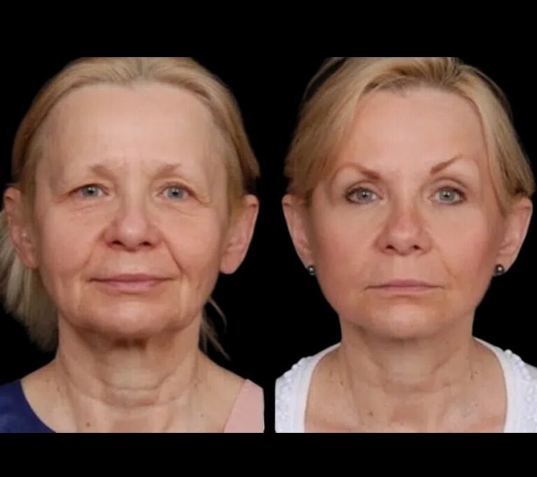 The Benefits of Getting Under Eye Fillers from the Best Plastic Surgeon in Dubai