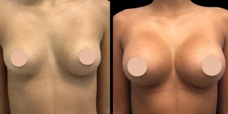Breast Augmentation in Dubai: Choosing the Right Surgeon for Your Breast Enhancement