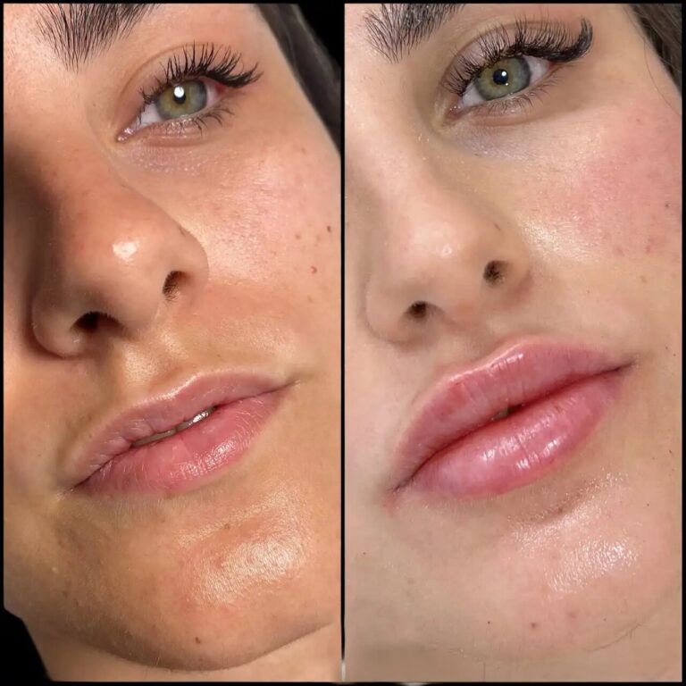 Explore the Best Aesthetic Clinics in dubai for Fillers Treatments
