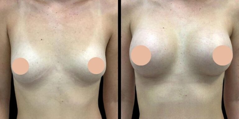 How the Best Doctors in Dubai Ensure Safety in Breast Enhancement Procedures
