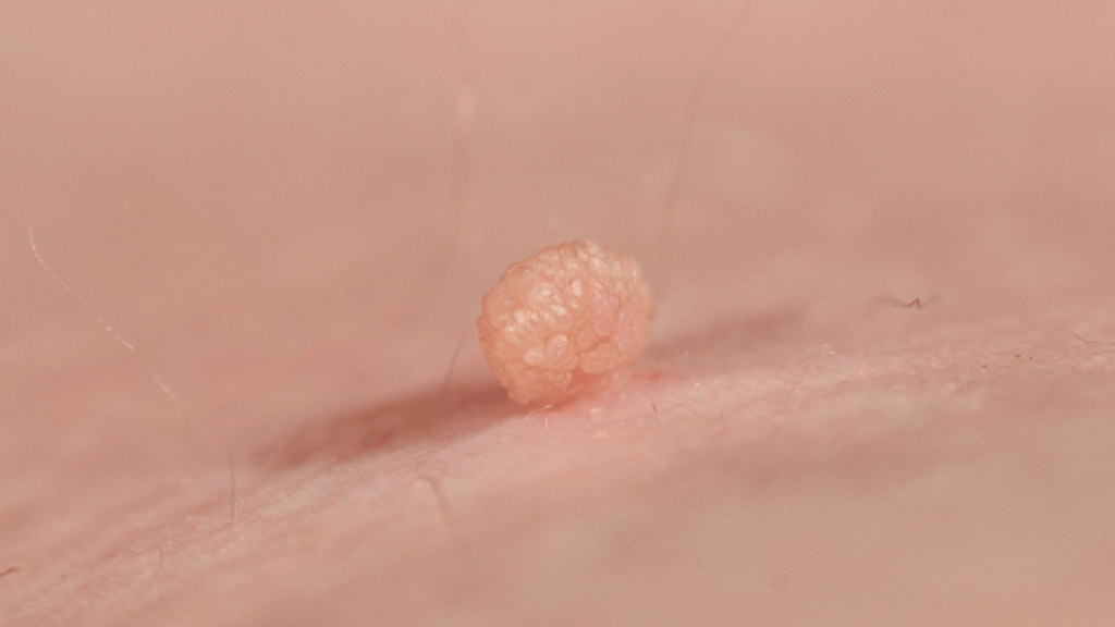 How Does An Anal Skin Tag Feel And Look