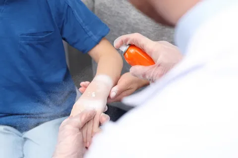 Burn Treatment