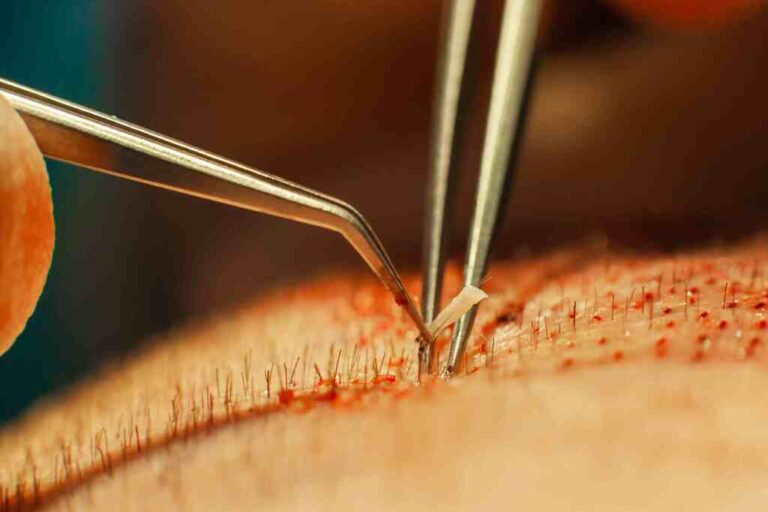 Overcoming Hair Loss and Depression