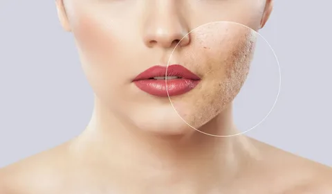 Beverly Hills Acne Treatment: Achieve Clear, Radiant Skin in the Heart of Luxury