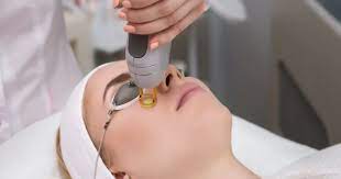 laser for dark spots
