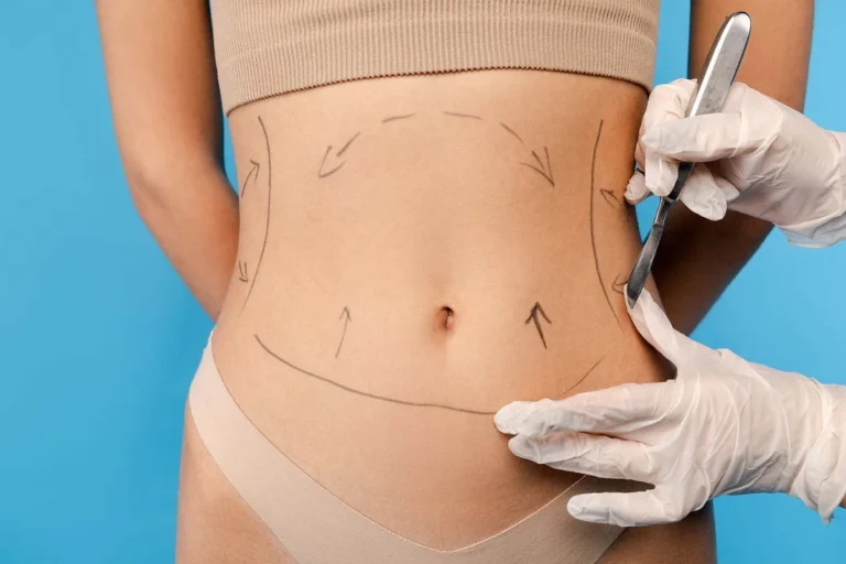How to Choose the Best Fat Transfer Surgeons in Dubai for Your Body Contouring Needs