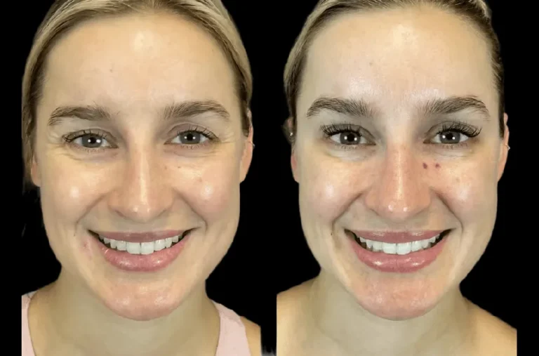 Best Aesthetic Clinic in dubai on the Rise of Botox for Jawline Contouring