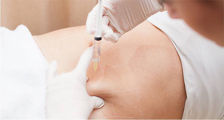 Transform Your Body with Fat Dissolving Injection: A Revolutionary Non-Surgical Solution