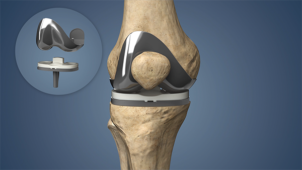Best Knee Replacement Surgeon in Jaipur