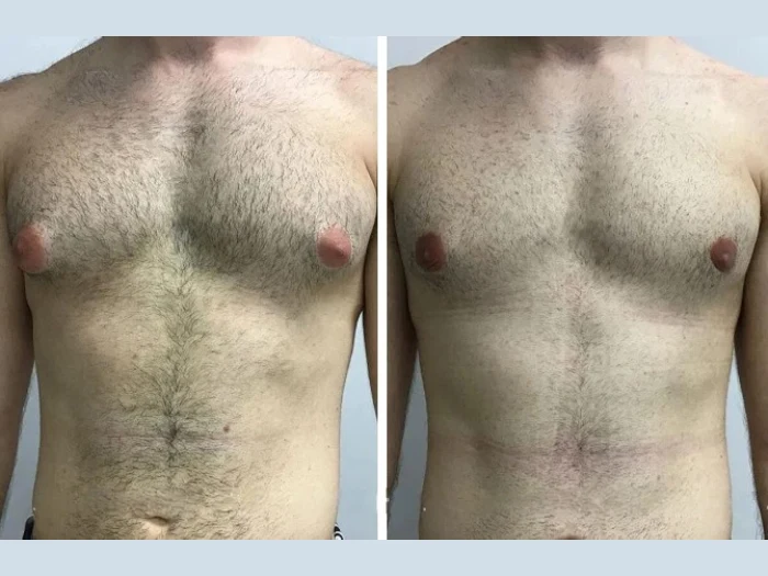Common Myths About Gynecomastia Surgery in Dubai – Debunked