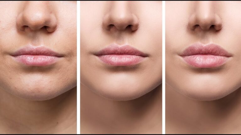 Affordable Lip Flip Treatments in Novi: Where to Go