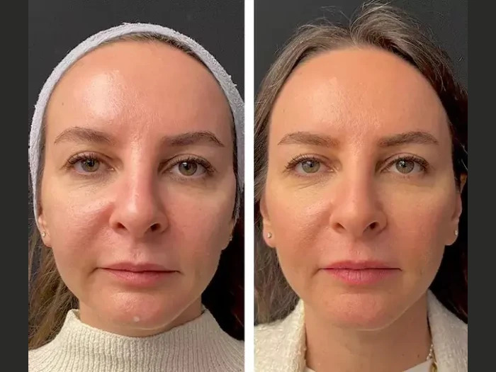 Secrets to Glowing Skin: Mesotherapy Tips from the Best Plastic Surgeons in Dubai