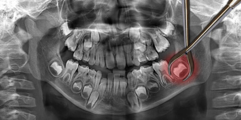 wisdom tooth surgery