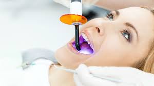 Foods to Avoid After Teeth Whitening – Lake Mary Dentist Tips
