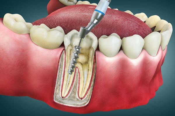 root canal